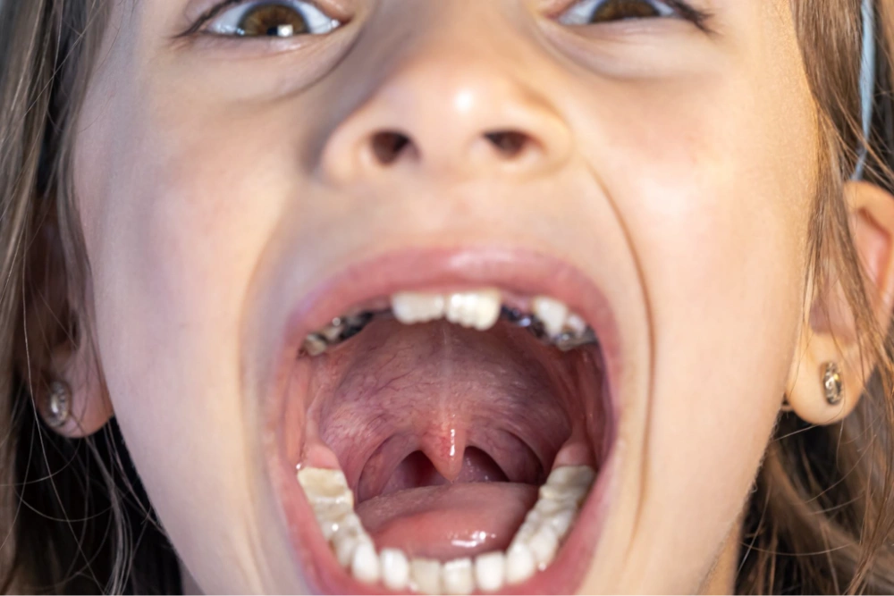Dental Caries: The Quiet Damage That Can Destroy Teeth