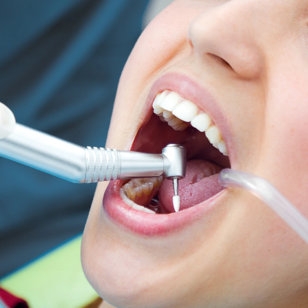 Scaling (Dental Spa)